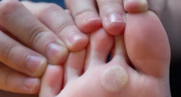 Warts, Nail & Callus Care Mobile Doctors Los Angeles